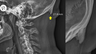 No, Using a Cellphone Isn't Causing You to Grow a Horn